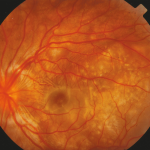 Exudative Retinal Detachment (RPE)