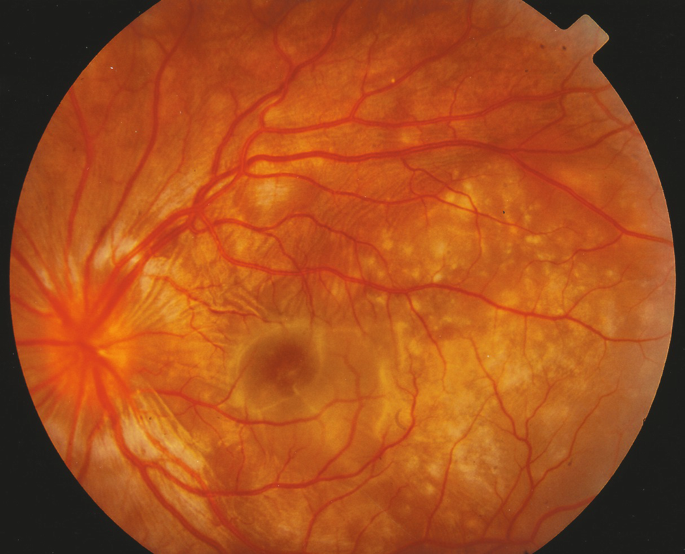 Exudative Retinal Detachment (RPE): Full study