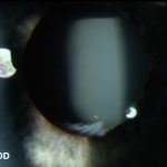 Capsular Bag Distension Syndrome