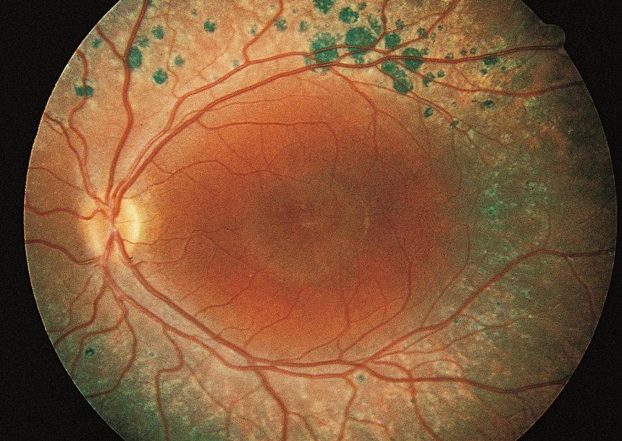 Enhanced S-Cone Syndrome