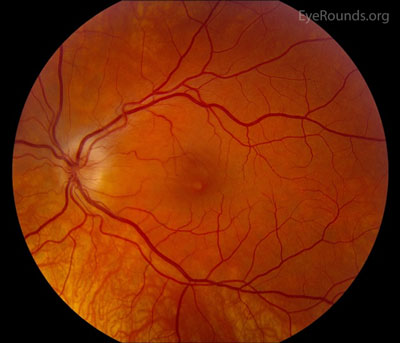 Neuroretinitis