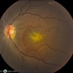 Neuroretinitis