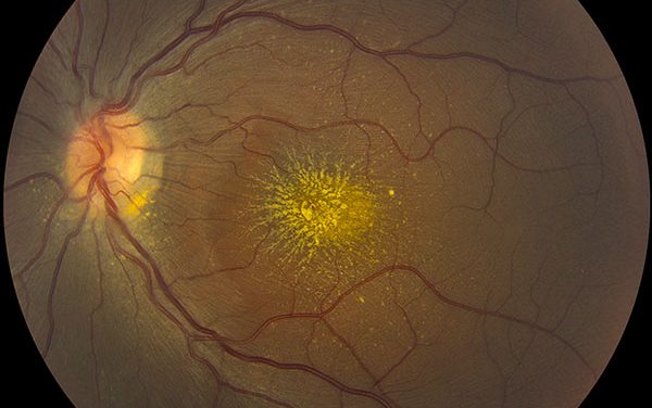 Neuroretinitis Unveiling : Vision Impairment and Therapeutic Approaches