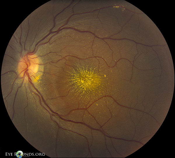 Neuroretinitis Unveiling : Vision Impairment and Therapeutic Approaches