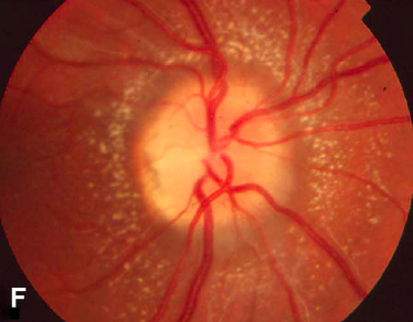 Neuroretinitis