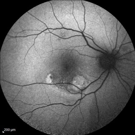 Polypoidal Choroidal Vasculopathy (PCV): Comprehensive Overview