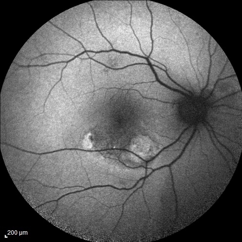 Polypoidal Choroidal Vasculopathy (PCV)