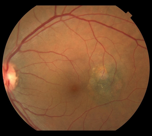 Polypoidal Choroidal Vasculopathy (PCV)