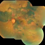 Polypoidal Choroidal Vasculopathy (PCV)