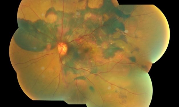 Polypoidal Choroidal Vasculopathy (PCV): Comprehensive Overview