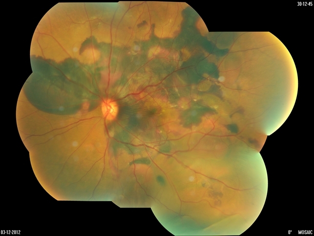 Polypoidal Choroidal Vasculopathy (PCV): Comprehensive Overview