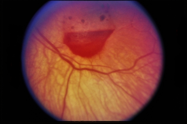 Terson Syndrome