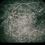 Vogt-Koyanagi-Harada Disease