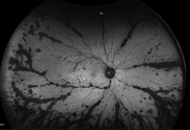 Vogt-Koyanagi-Harada Disease