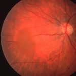 Terson Syndrome