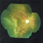 Uveal Effusion Syndrome