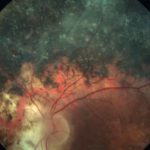 Enhanced S-Cone Syndrome