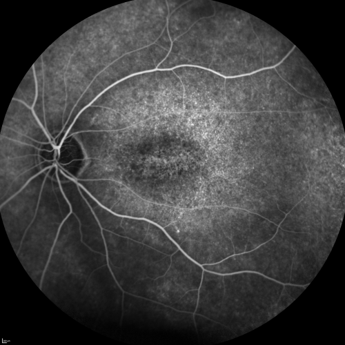 Enhanced S-Cone Syndrome