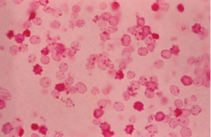 Ghost Cell Glaucoma