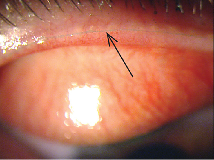 Lid Wiper Epitheliopathy 