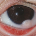 Goldenhar Syndrome