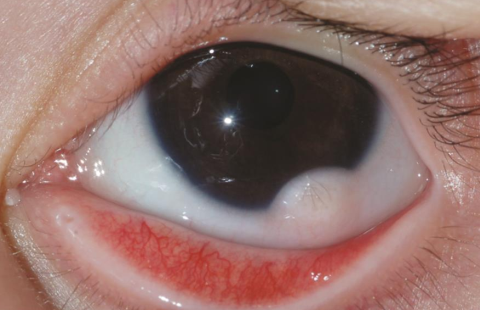 Goldenhar Syndrome: Detailed Case Study and Treatment Approach