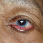Ectropion