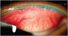  Lid Wiper Epitheliopathy