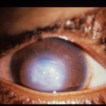 Acute Corneal Hydrops