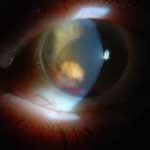 Ghost Cell Glaucoma