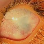Sclerocornea