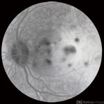 Sympathetic ophthalmia