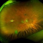 Gardner Syndrome