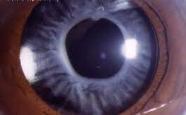 Anterior Capsular Contraction Syndrome