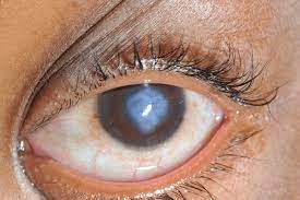 Acute Corneal Hydrops