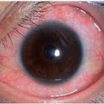 Acute Anterior Uveitis (AAU)