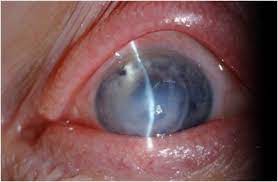 Acute Corneal Hydrops