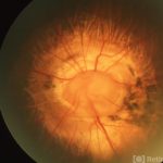 Morning Glory Syndrome
