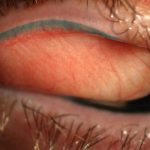 Lid Wiper Epitheliopathy