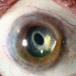 Anterior Capsular Contraction Syndrome