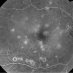 West Nile Retinopathy
