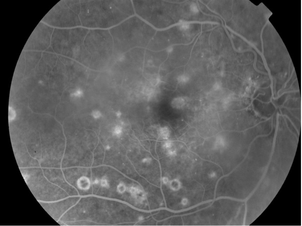West Nile Retinopathy: a detailed review