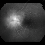Pseudopapilledema
