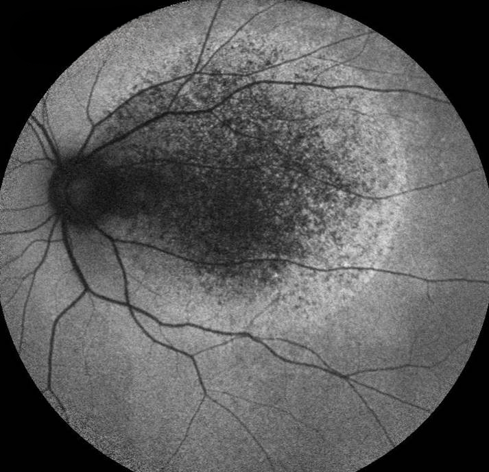 Sorsby Macular Dystrophy