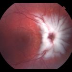 Myelinated Retinal Nerve Fiber Layer
