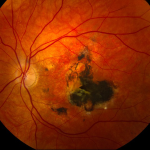 Sorsby Macular Dystrophy