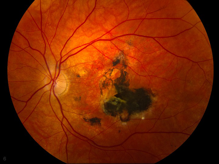 Sorsby Fundus Dystrophy: Promising Therapeutic Approaches