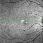 Acute Macular Neuroretinopathy