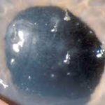 Filamentary Keratitis