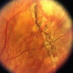 Wagner Syndrome